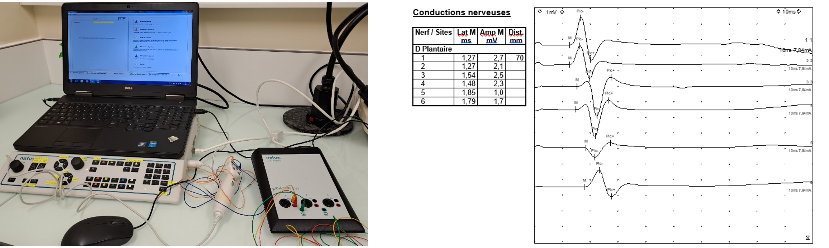 Mesure d'électromyogramme